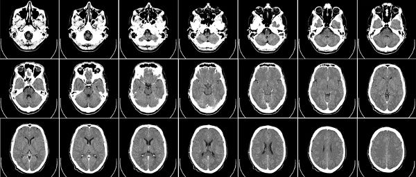 MRT-Bilder eines Gehirns